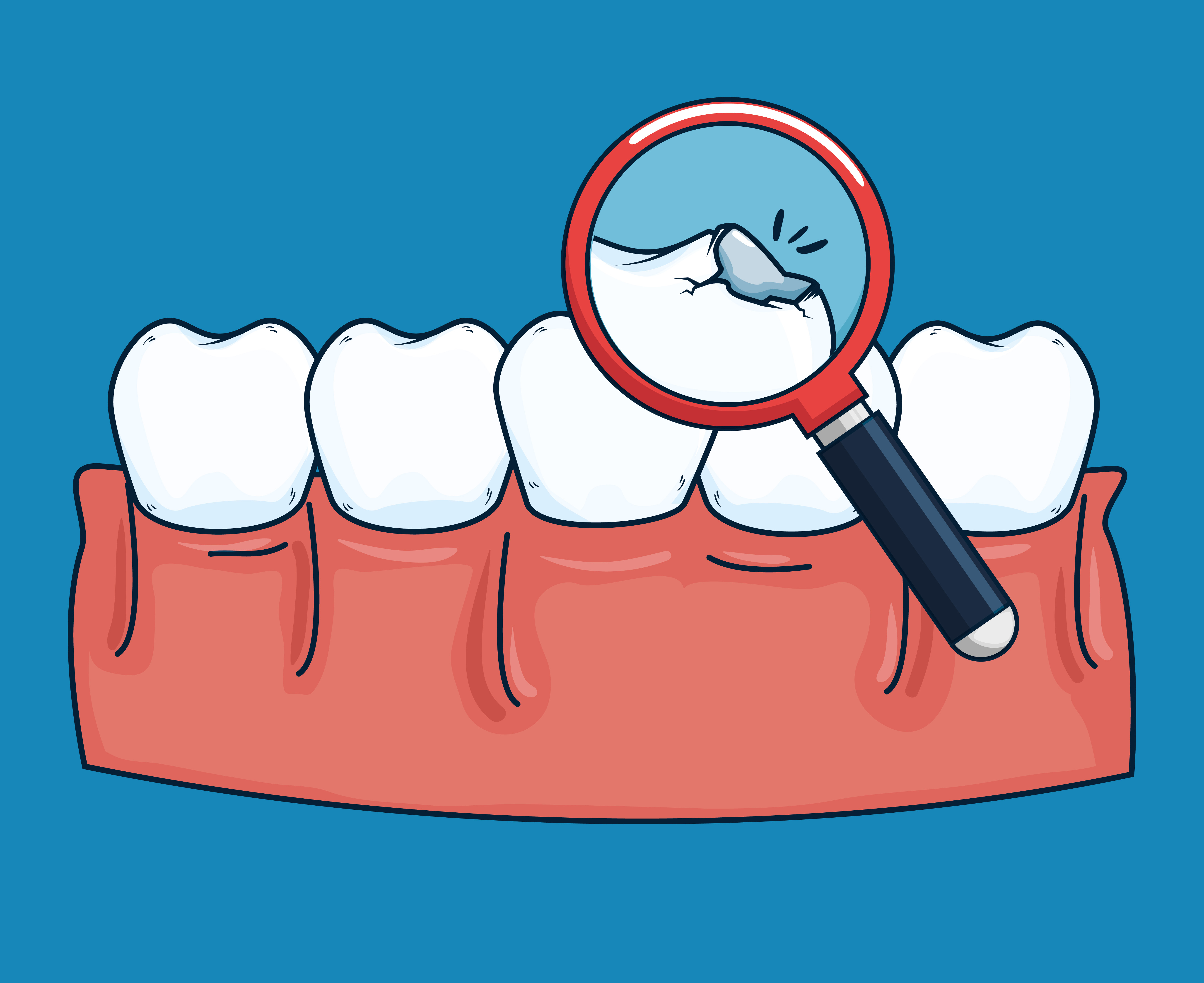Beragam Penyebab Gigi Retak & Cara Mengatasinya